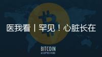 医我看丨罕见！心脏长在右胸膛
！珠海成功开展首例“右位心”房颤射频消融术